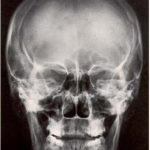 radiografía-posteroanterior